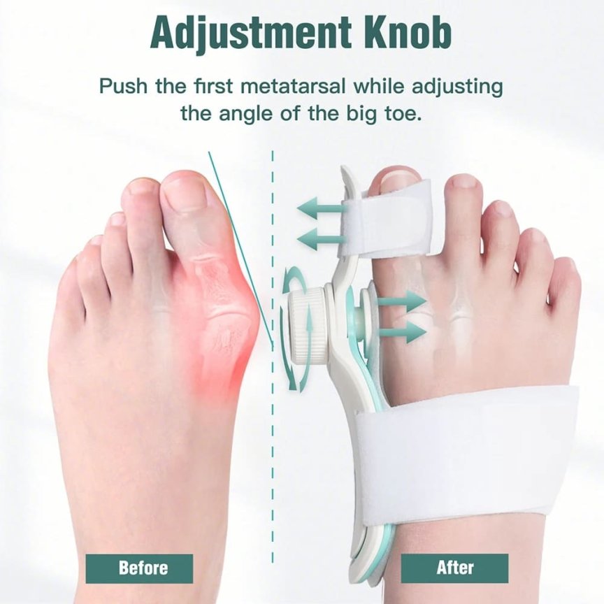 Korektor na haluxy – ortopedická ortéza na vybočený palec nohy Hallux Valgus